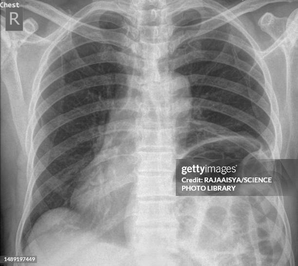 hiatus hernia, x-ray - hernia de hiato fotografías e imágenes de stock