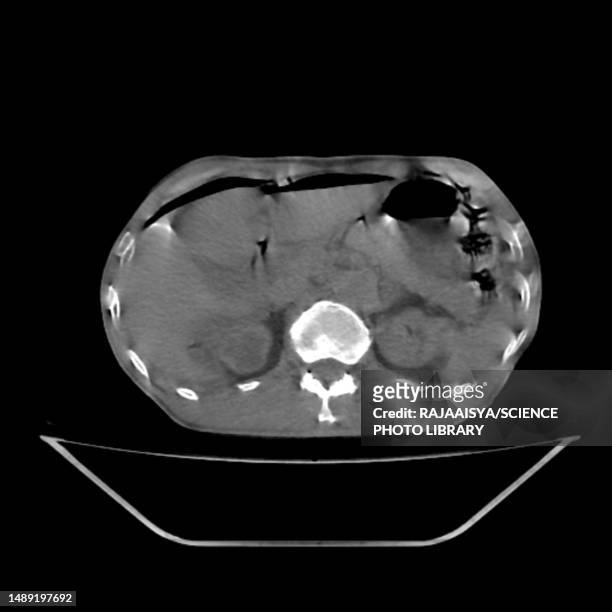 pneumoperitoneum, ct scan - 腹膜腔 ストックフォトと画像