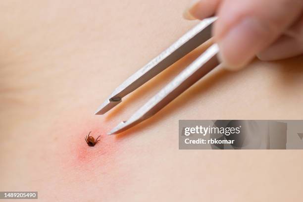 removal with tweezers of a forest tick sucking blood in the human body - close-up - lymekrankheit stock-fotos und bilder