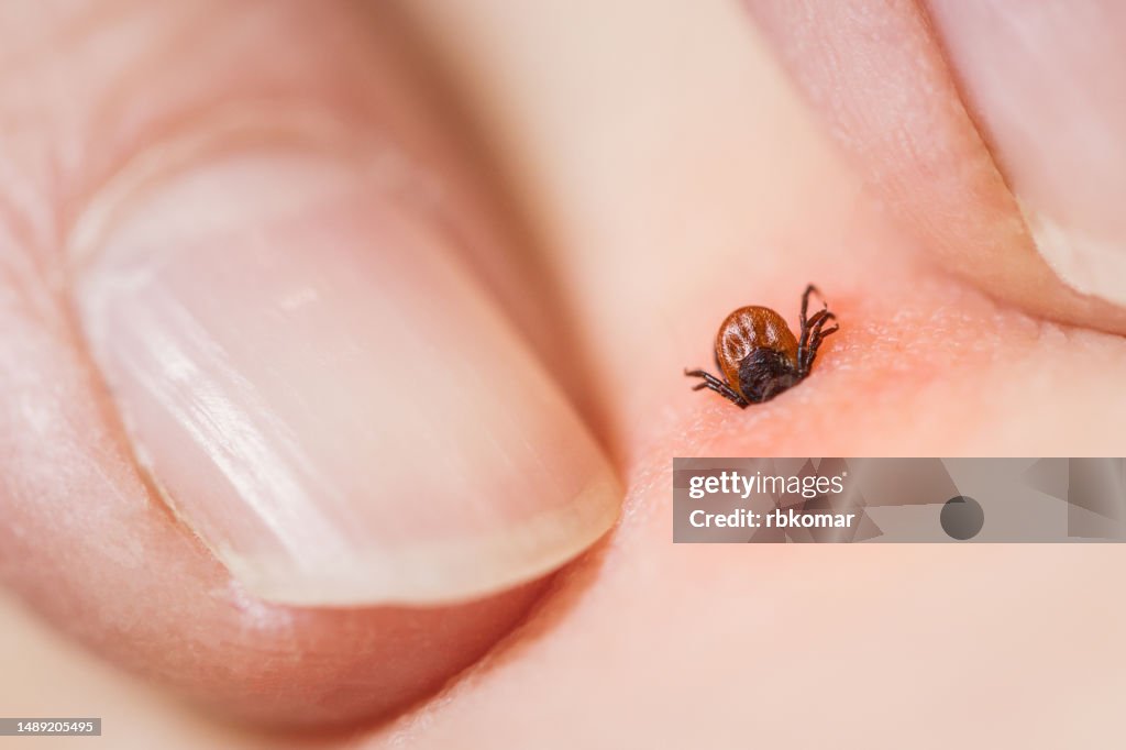 Tick bite - inflammation and irritation of the skin. Risk of infection with encephalitis or Lyme disease