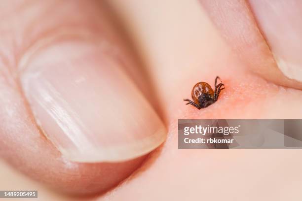 tick bite - inflammation and irritation of the skin. risk of infection with encephalitis or lyme disease - lyme disease bite stockfoto's en -beelden