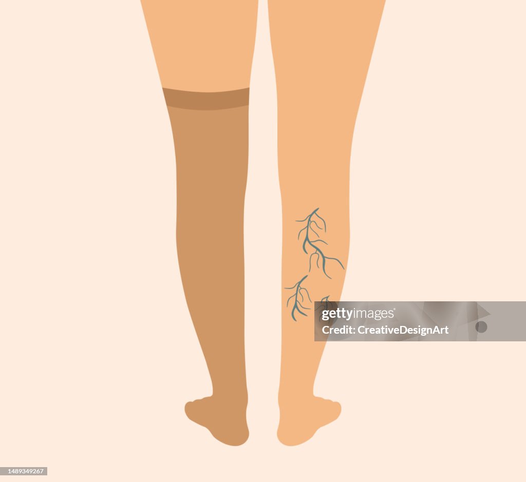 Legs With Varicose Veins Wearing Compression Stocking. Varicose Veins, Venous Insufficiency, Compression Stocking And Vascular Disease Concept