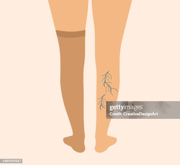 legs with varicose veins wearing compression stocking. varicose veins, venous insufficiency, compression stocking and vascular disease concept - compression garment stock illustrations