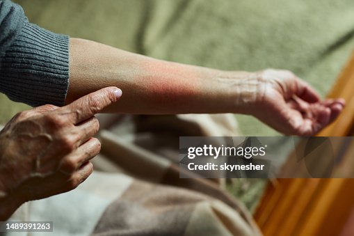 Look at my red rash! Look at my red rash!