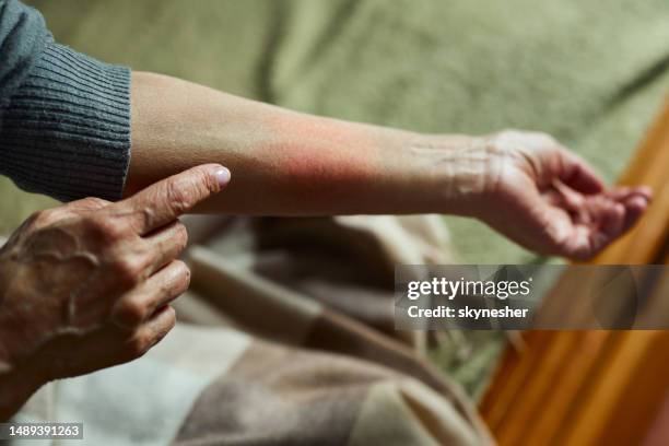 look at my red rash! - eczema stock pictures, royalty-free photos & images
