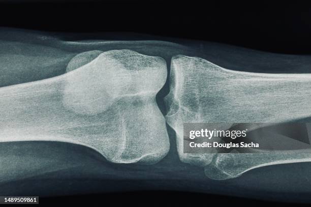 orthopedic surgery viewing imaging - hueso humano fotografías e imágenes de stock