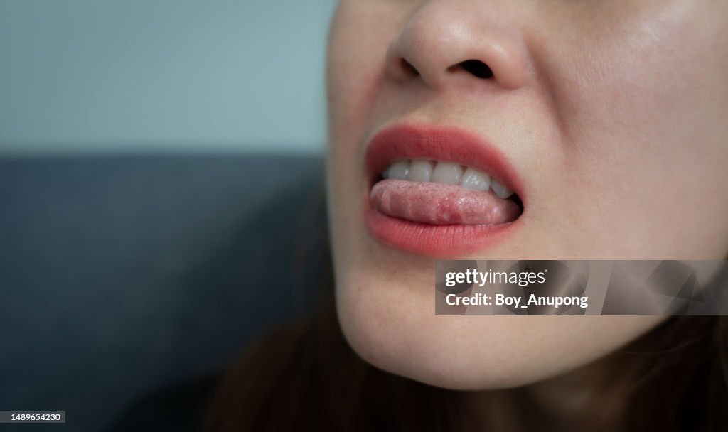 Cropped shot of woman having mouth ulcer occur on her tongue. Mouth ulcers are painful sores that appear in the mouth.