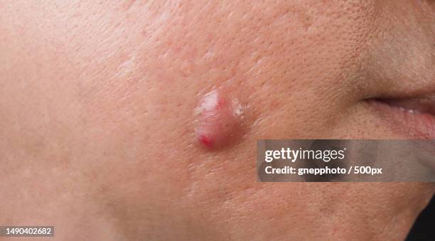 big acne cyst abscess or ulcer swollen area within face skin tissue,bangkok,thailand - abscess stock-fotos und bilder