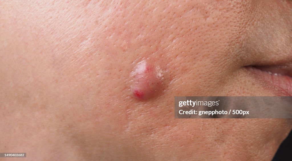 Big Acne Cyst Abscess or Ulcer Swollen area within face skin tissue,Bangkok,Thailand