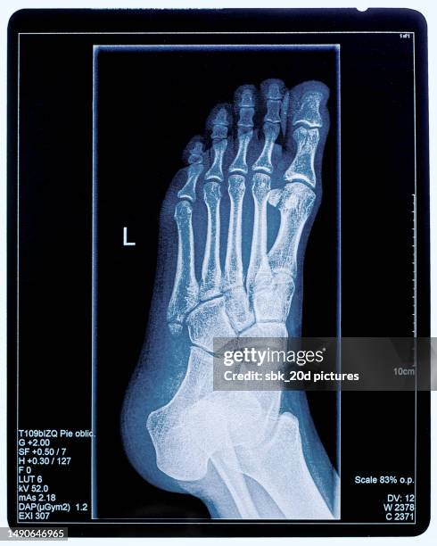 x-ray woman 02 - röntgenbild bildbanksfoton och bilder