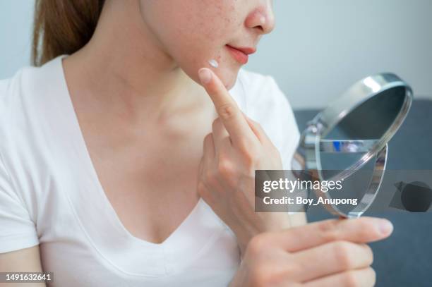 cropped shot of woman trying to applying acne cream on her skin for solving acne problem. - pimple stock pictures, royalty-free photos & images