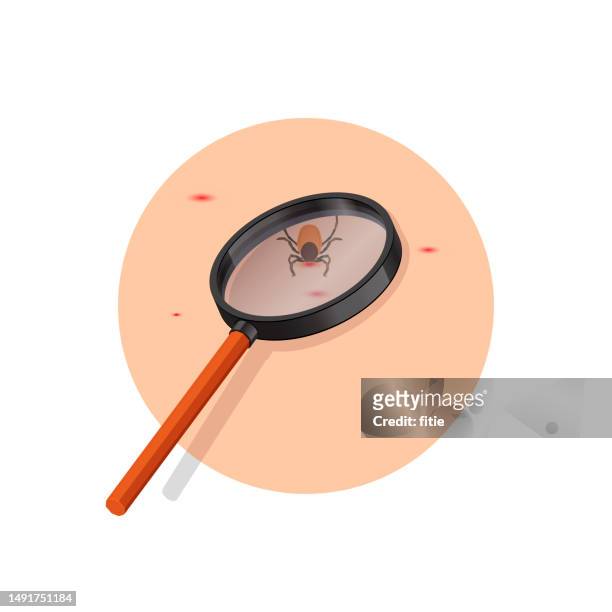 stockillustraties, clipart, cartoons en iconen met removing encephalitis ticks after bite. how to remove mite. parasite carrying disease.using magnifying glass to find ticks. - lyme disease bite