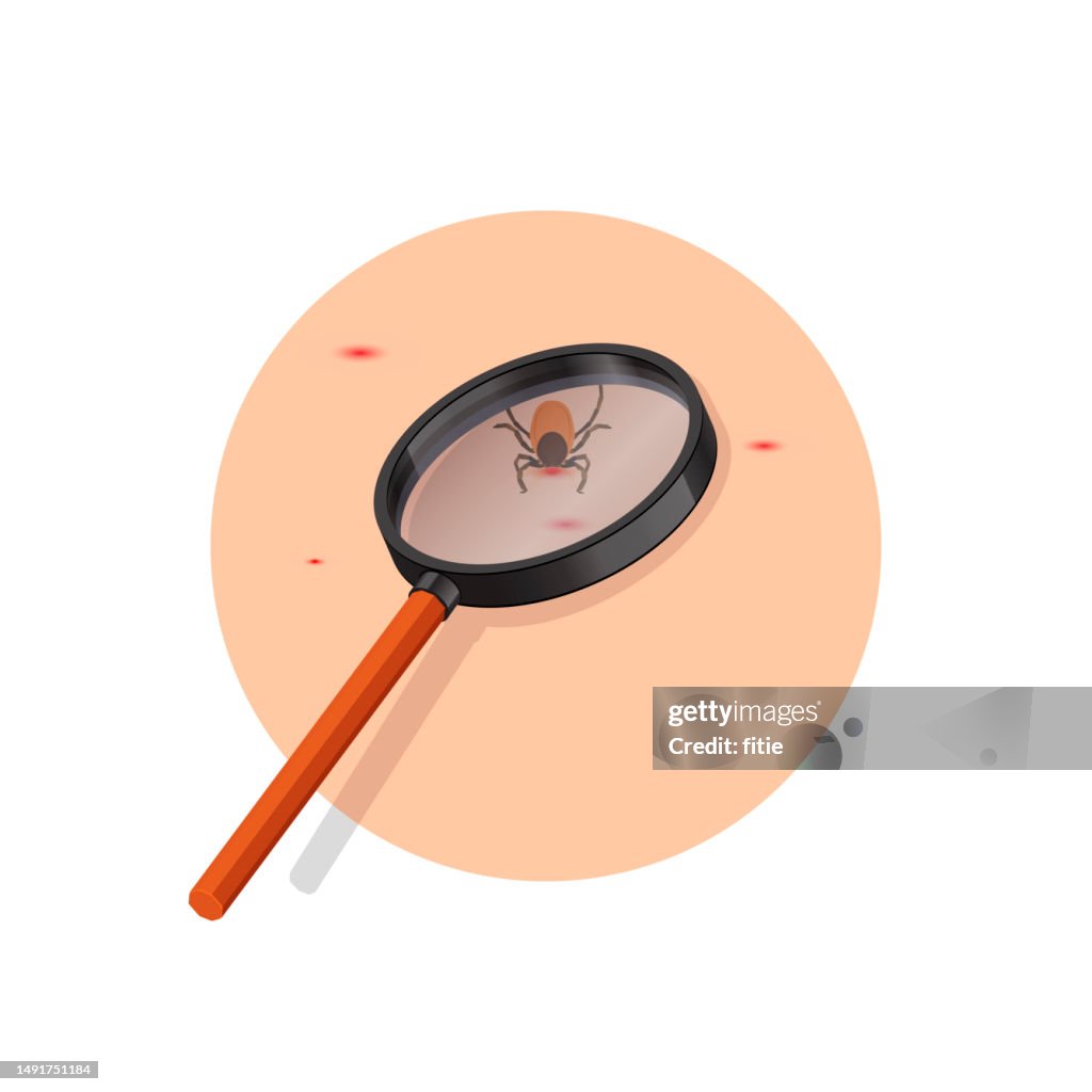 Removing encephalitis ticks after bite. How to remove mite. Parasite carrying disease.Using magnifying glass to find ticks.