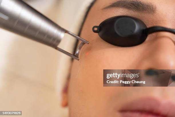 an young asian male client is having a laser treament in a beauty centre. - laser face stock pictures, royalty-free photos & images