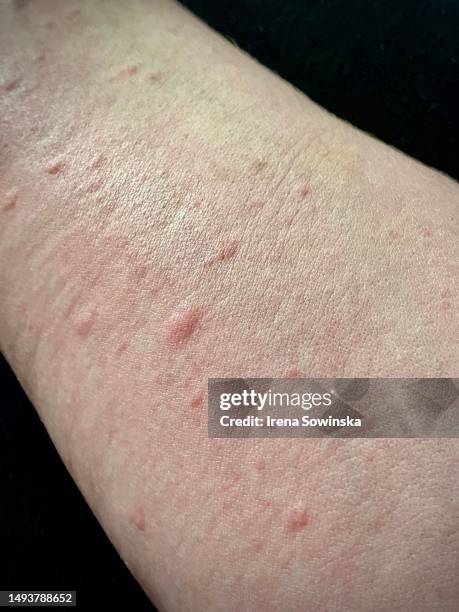 72 Skin Rash Doctor Stock Photos, High-Res Pictures, and Images - Getty ...