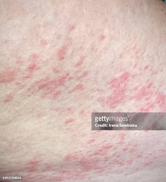 Allergic reaction skin rash hi-res stock photography and images