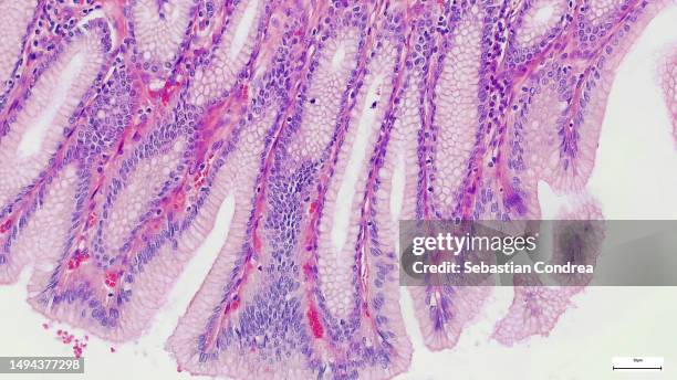 microscope of adenoid cystic carcinoma, rare type of cancer exist in many different body sites. - vetenskaplig mikroskopfotografering bildbanksfoton och bilder