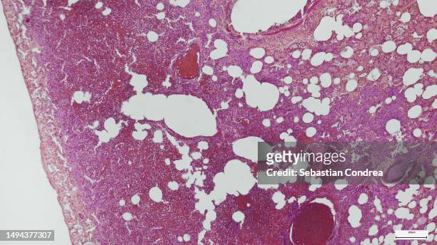 microscope of adenoid cystic carcinoma, rare type of cancer exist in many different body sites. - fuoco di sant'antonio foto e immagini stock