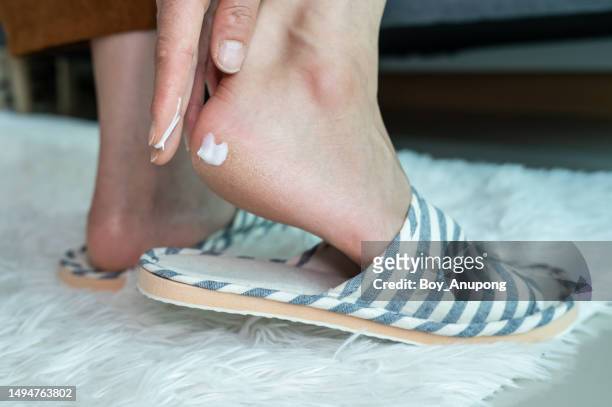 close up of person applying moisturizer on foot for treat cracked heel problem. cracked heels occur when dry, thick skin on the bottom of your heels cracks and splits. - foot fungus stock pictures, royalty-free photos & images