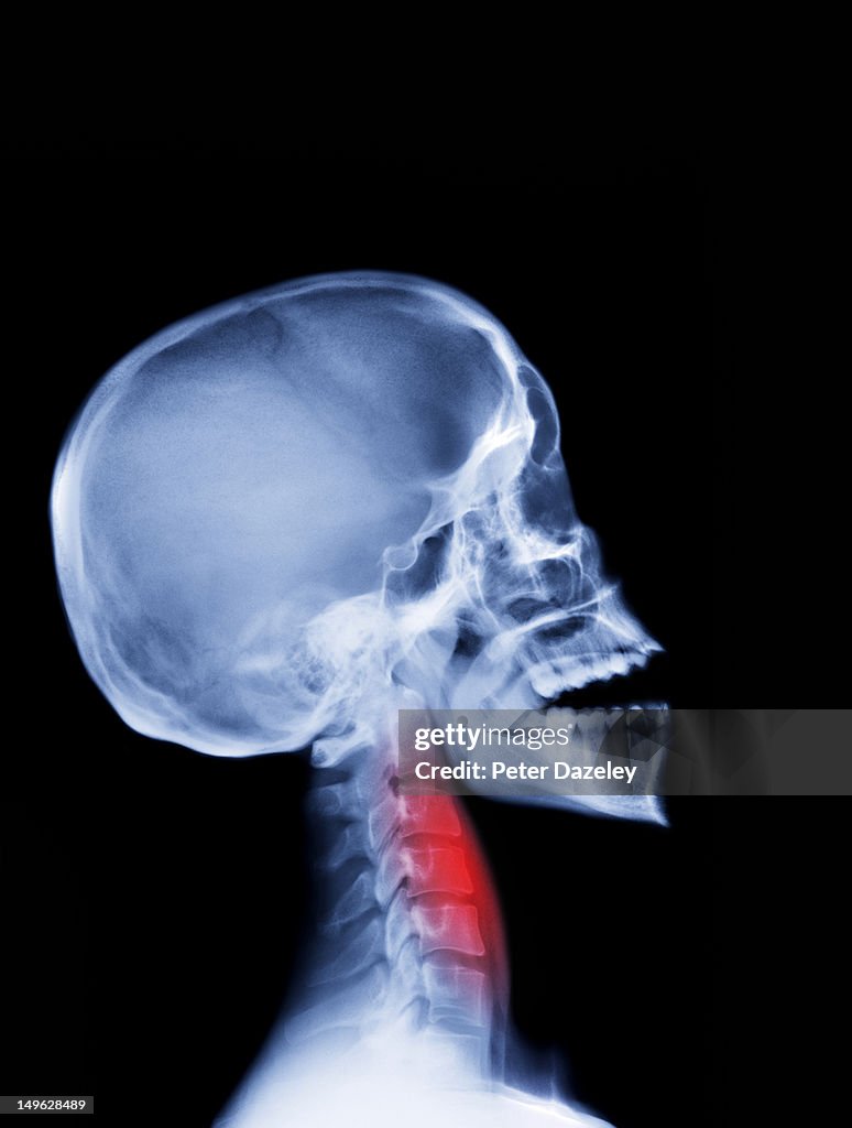 Sore throat x-ray