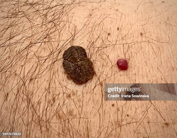 skin melanoma - mole skin stock pictures, royalty-free photos & images