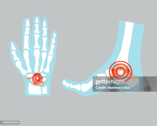 schädigung menschlicher hand- und fußknochen - skelett hand stock-grafiken, -clipart, -cartoons und -symbole