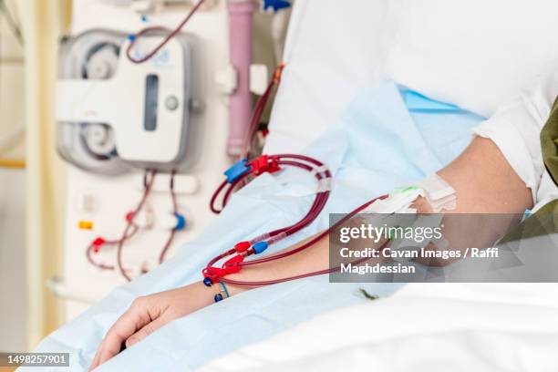 arm of a patient with a hemodialysis catheter during a treatment - dialysis stock pictures, royalty-free photos & images