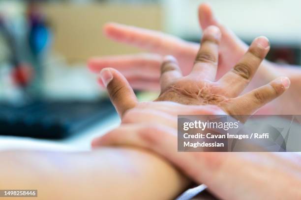 an occupational therapist works the hand of a burnt child - ergotherapie stock-fotos und bilder