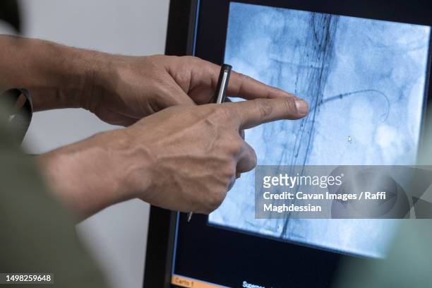 heart catheter when replacing an aortic valve - blutgefäss stock-fotos und bilder