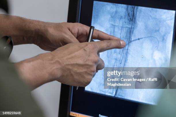 heart catheter when replacing an aortic valve - vaso sanguigno foto e immagini stock