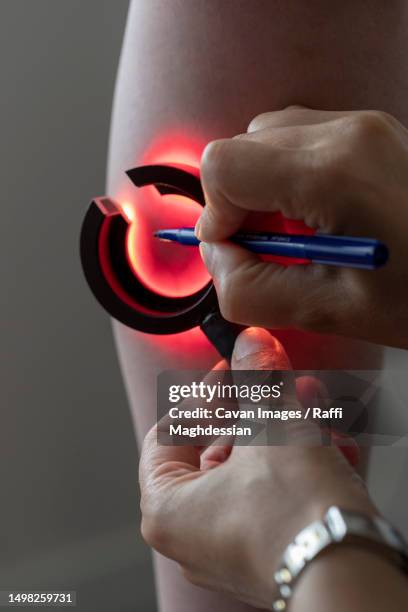 a doctor looks for varicose veins in a patient - krampfader stock-fotos und bilder