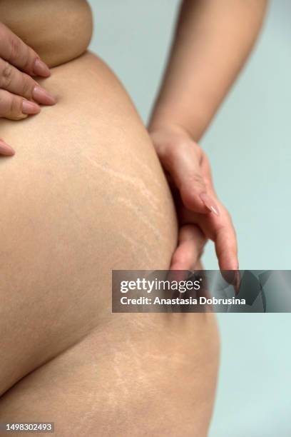 close-up of female hip with a stretch marks - skin mark stock pictures, royalty-free photos & images