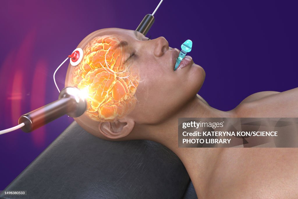 Ect Process Electroconvulsive Therapy Illustration High-Res Vector Graphic - Getty ...