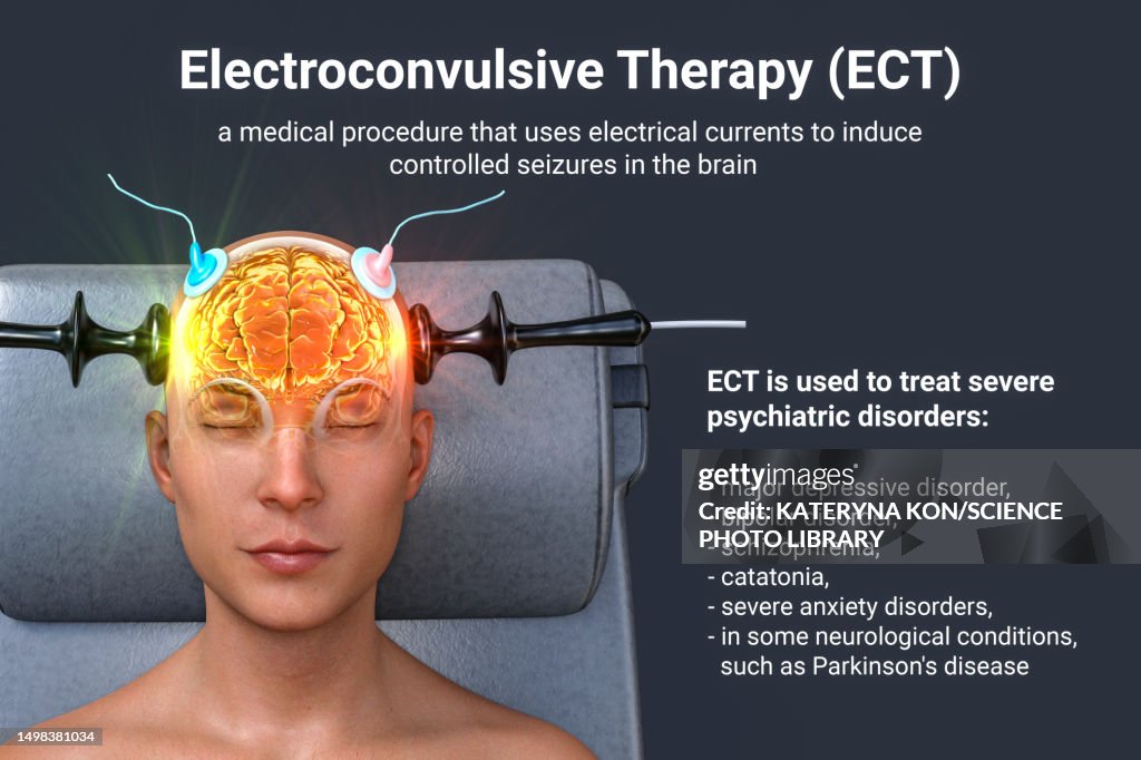 Ect Introduction Electroconvulsive Therapy Illustration High-Res Vector Graphic - Getty ...