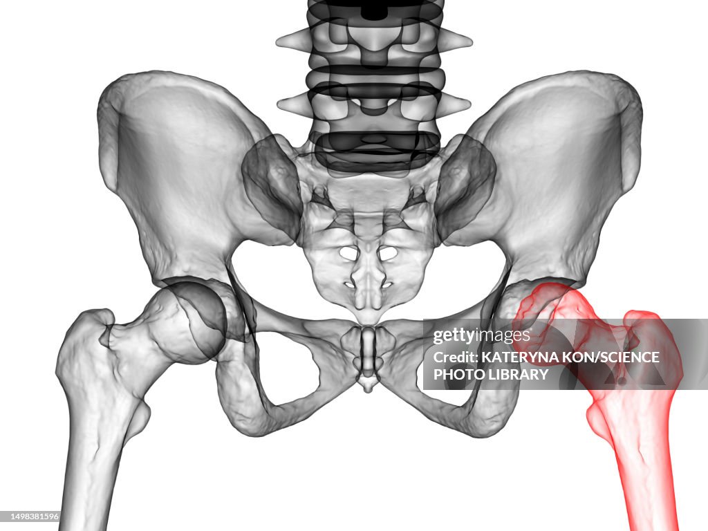 Legg-Calve-Perthes disease, illustration
