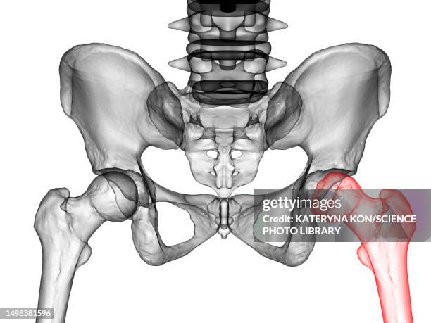 legg-calve-perthes disease, illustration - animal bone stock illustrations
