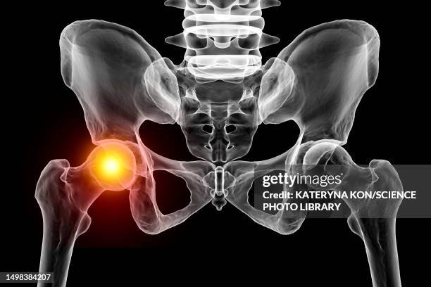 hip joint pain, conceptual illustration - gelenkrheumatismus stock-grafiken, -clipart, -cartoons und -symbole