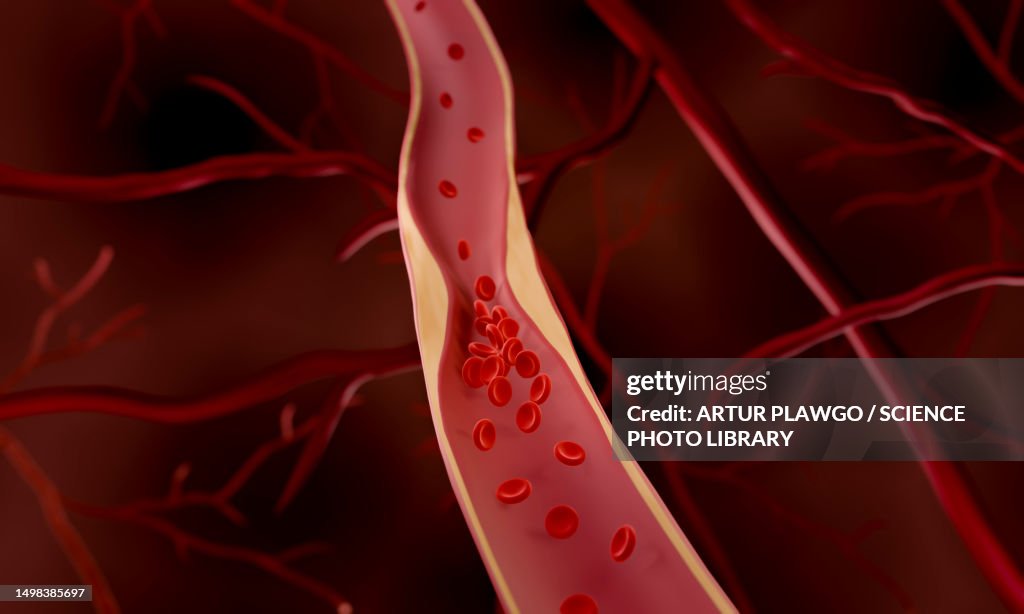 Atherosclerosis, illustration