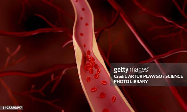 atherosclerosis, illustration - clogged artery stock illustrations