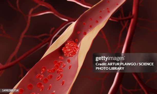 stockillustraties, clipart, cartoons en iconen met blood clot, illustration - cholesterol