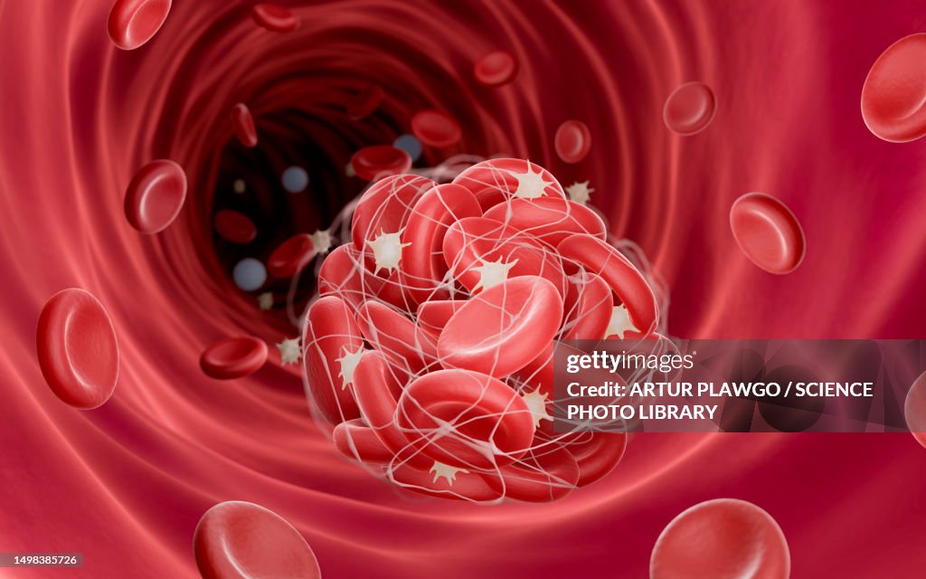 Blood clot, illustration