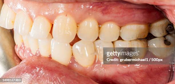 close-up of man with braces - gingivitis stock-fotos und bilder