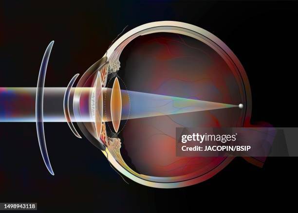 presbyopia treatment drawing - posterior chamber stock illustrations