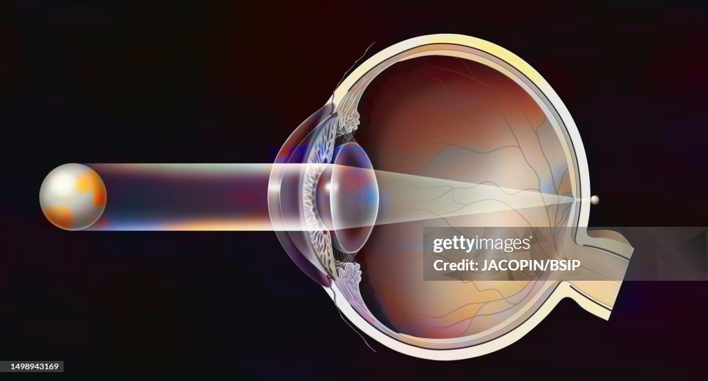 Hyperopia Drawing Hyperopia Drawing High-Res Vector Graphic - Getty Images