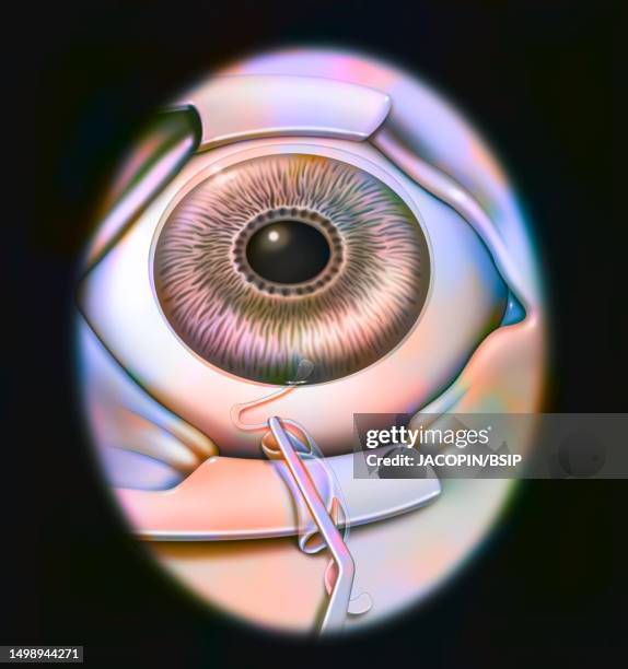 intra ocular implant - refractive surgery stock illustrations