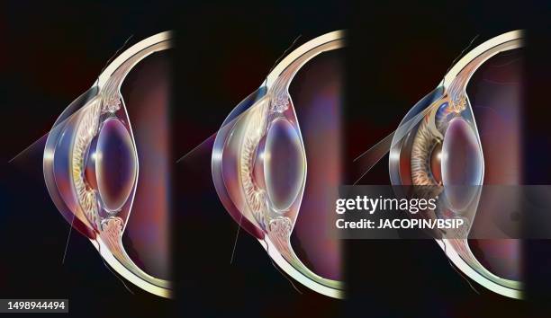 glaucoma drawing - posterior chamber stock illustrations