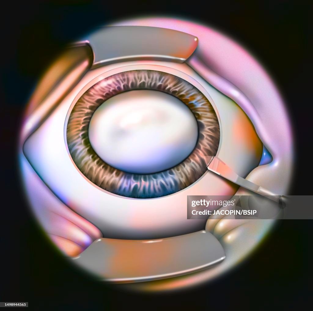 Cataract surgery drawing