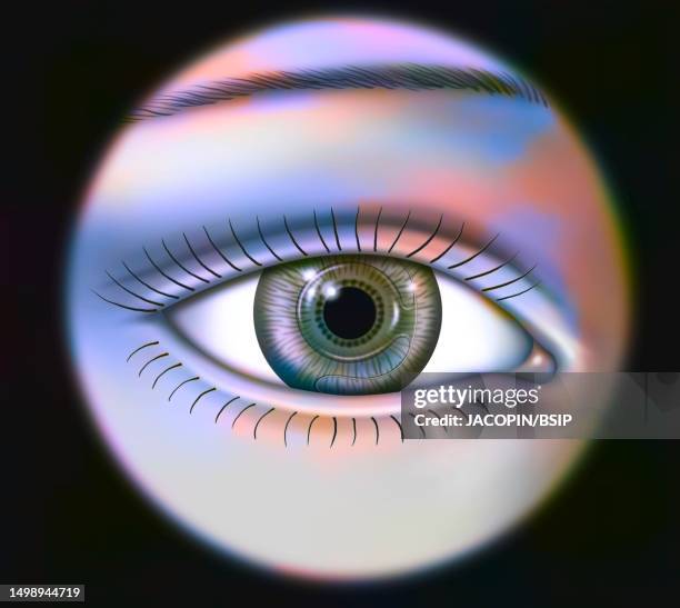 intra ocular implant - anterior chamber stock illustrations