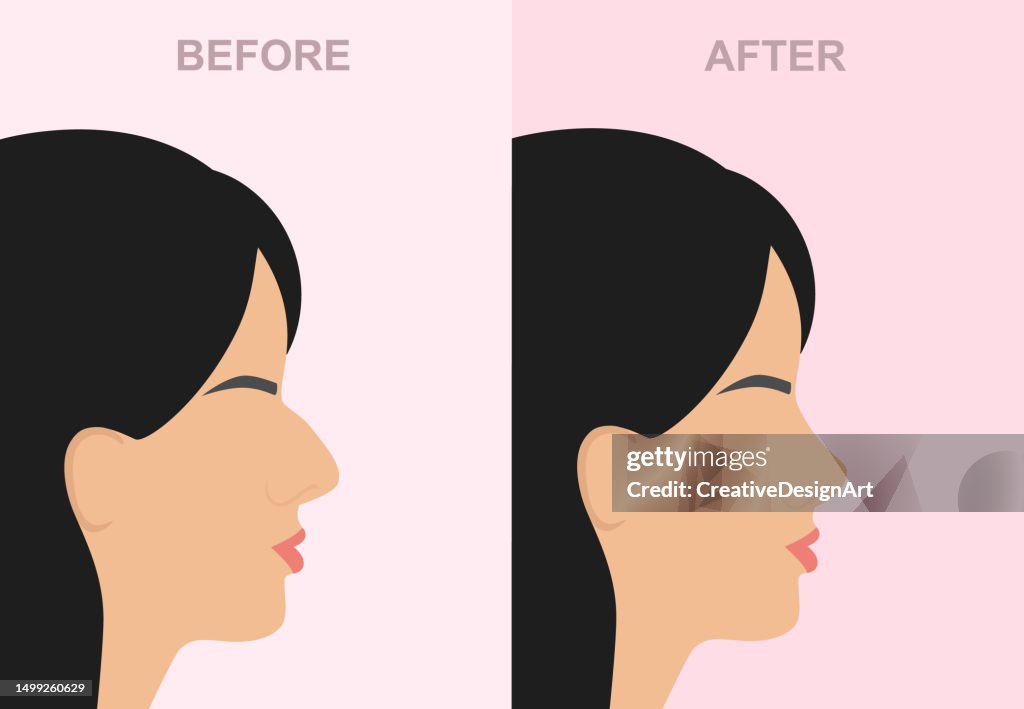 Side View Of Woman's Face With Before And After Rhinoplasty