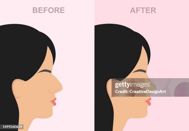 side view of woman's face with before and after rhinoplasty - chin stock illustrations